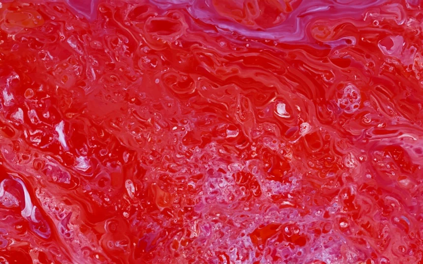 Anemia