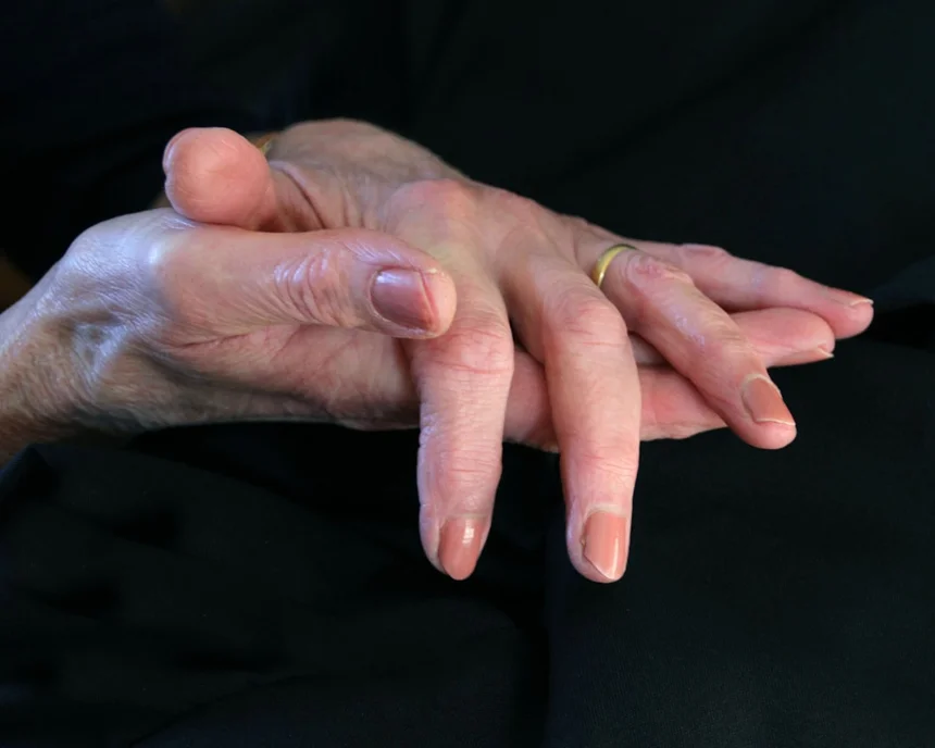 Arthritis