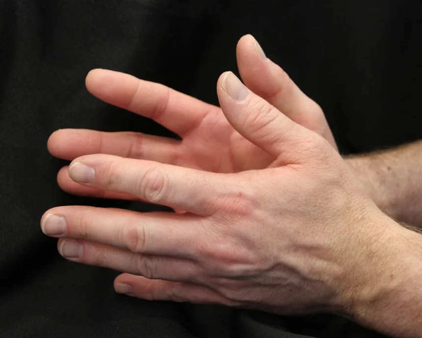 Arthritis