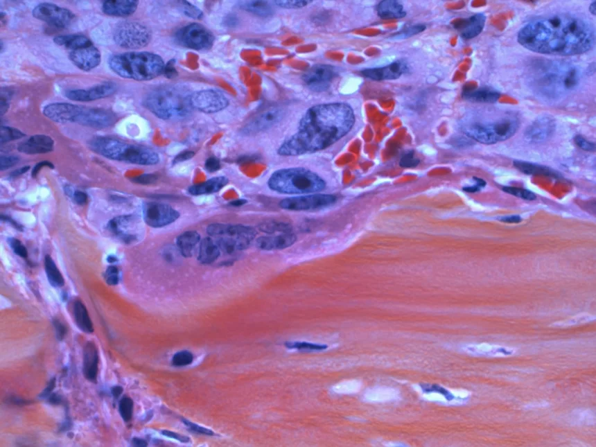 Atherosclerosis