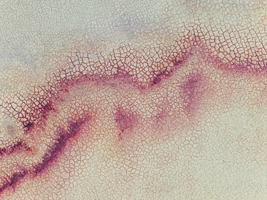 Eczema