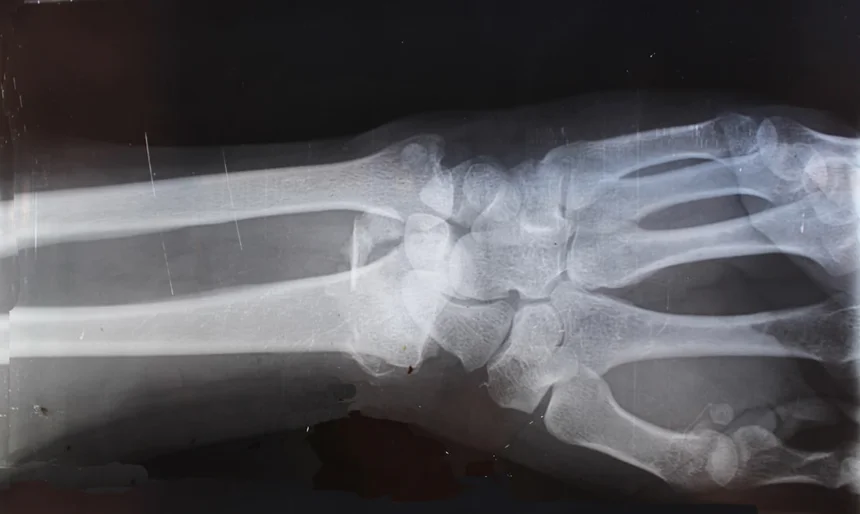 Fracture