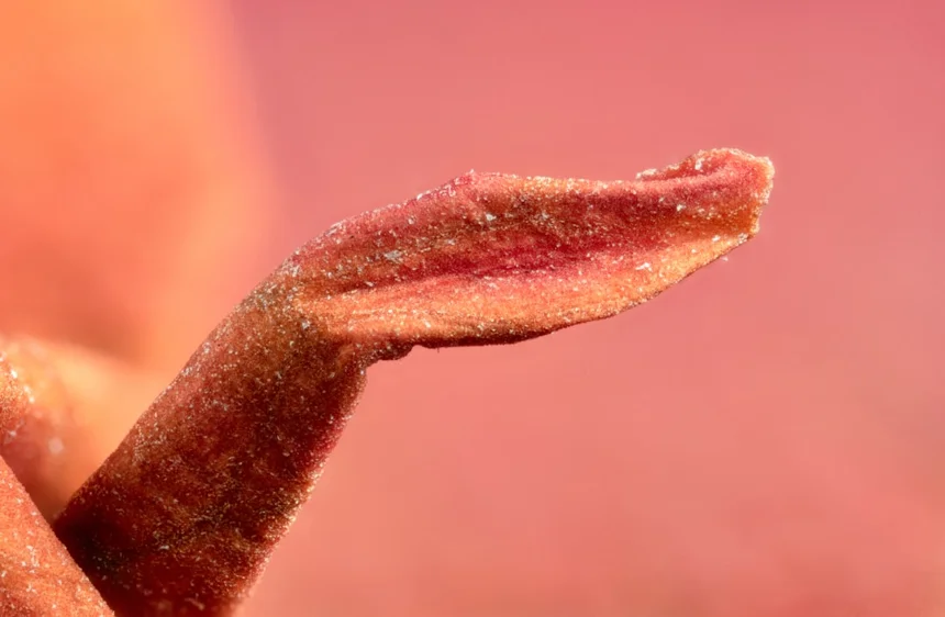 Gingivitis