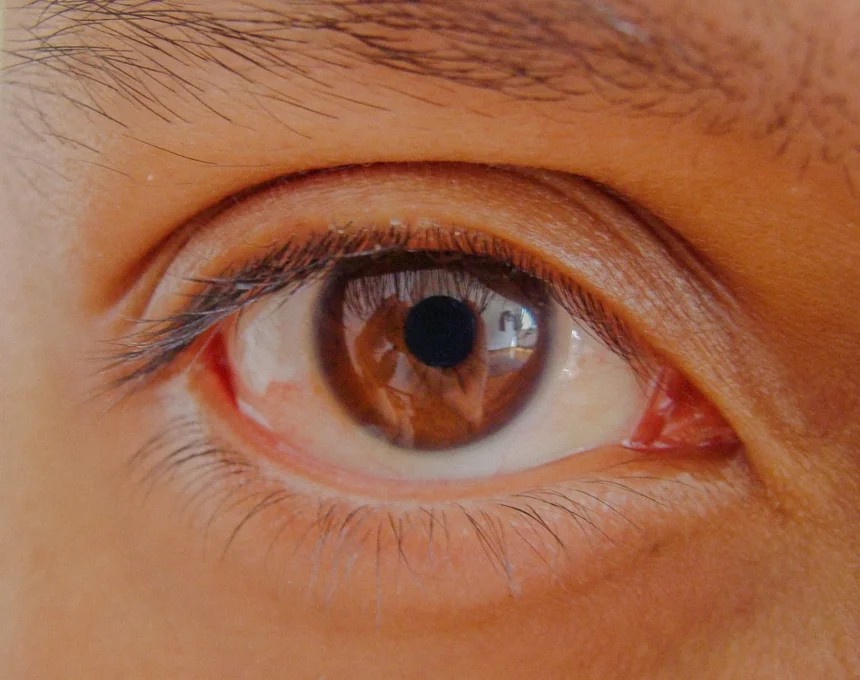 Glaucoma