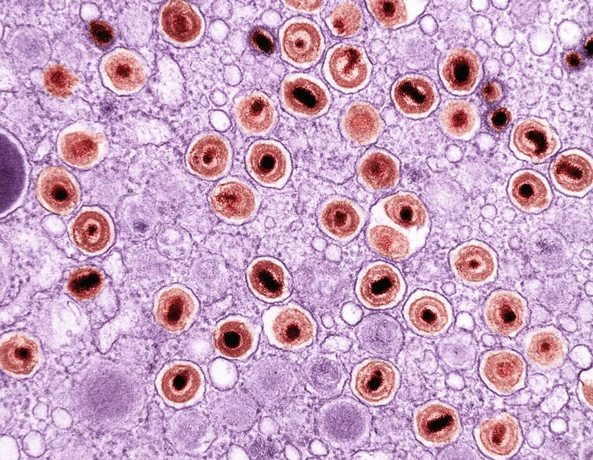 Hepatitis