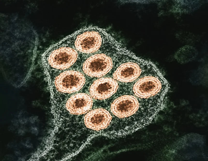 Herpes