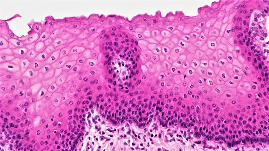 Keratitis
