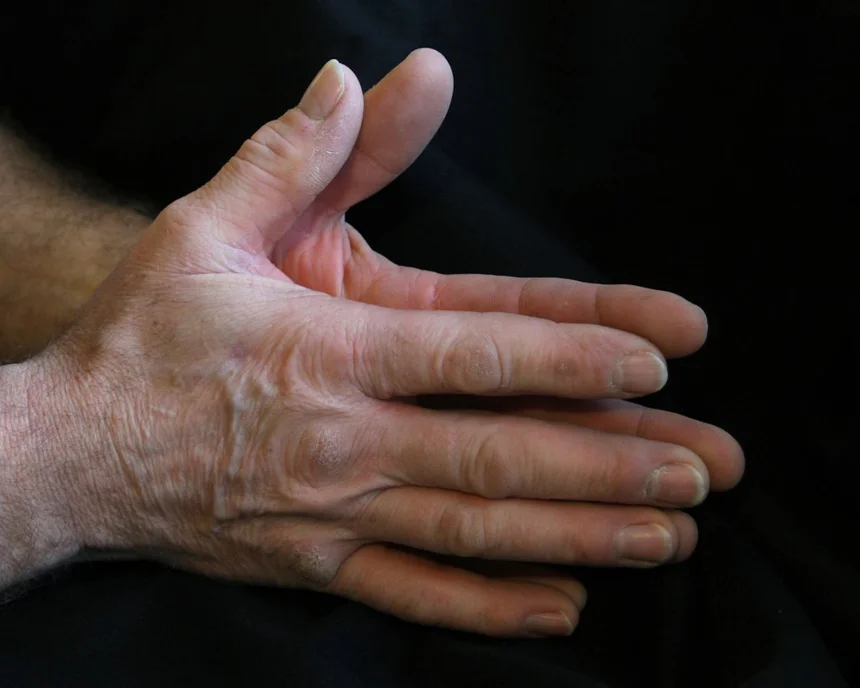 Osteoarthritis