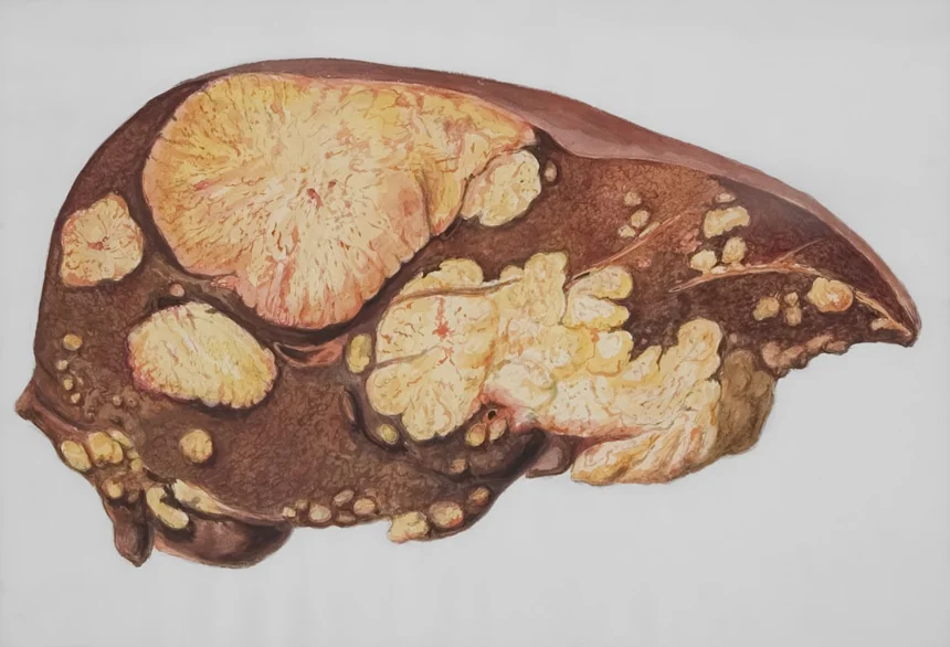 Pancreatic cancer