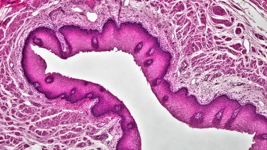 Psoriasis