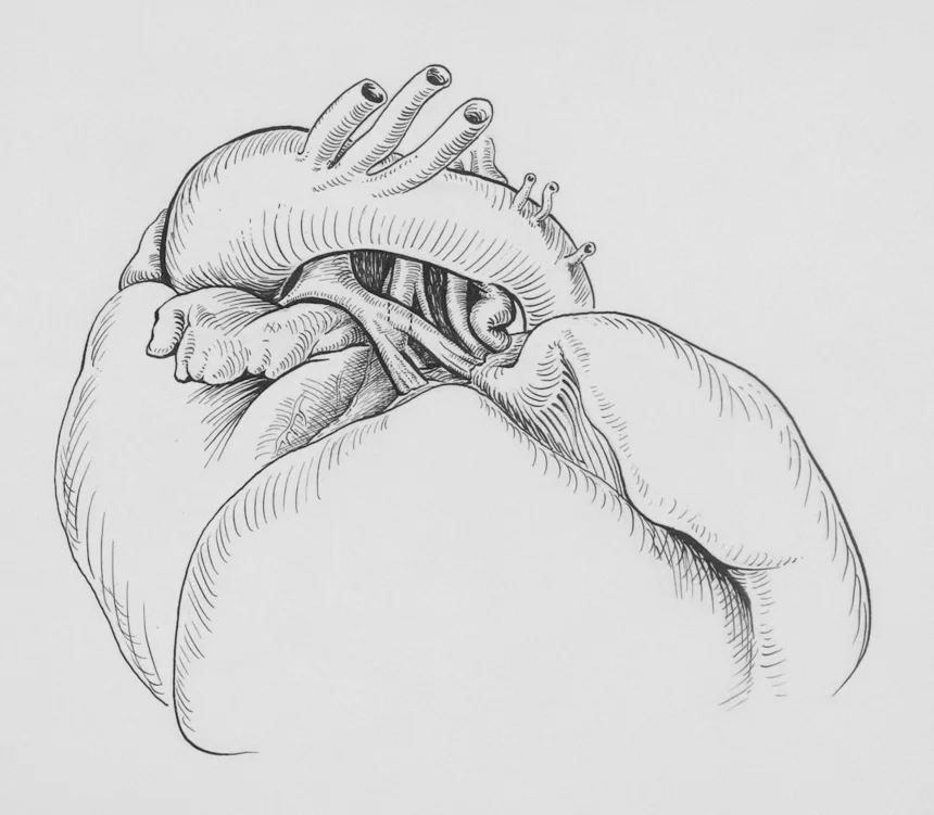 Rhinitis