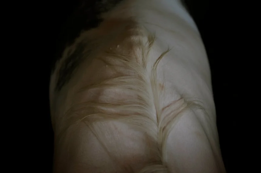 Stretch marks