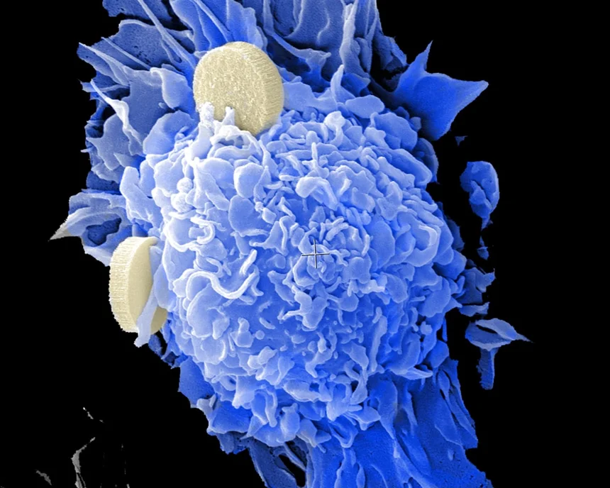 Testicular cancer