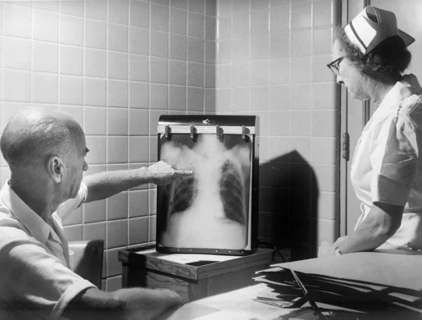 Tuberculosis
