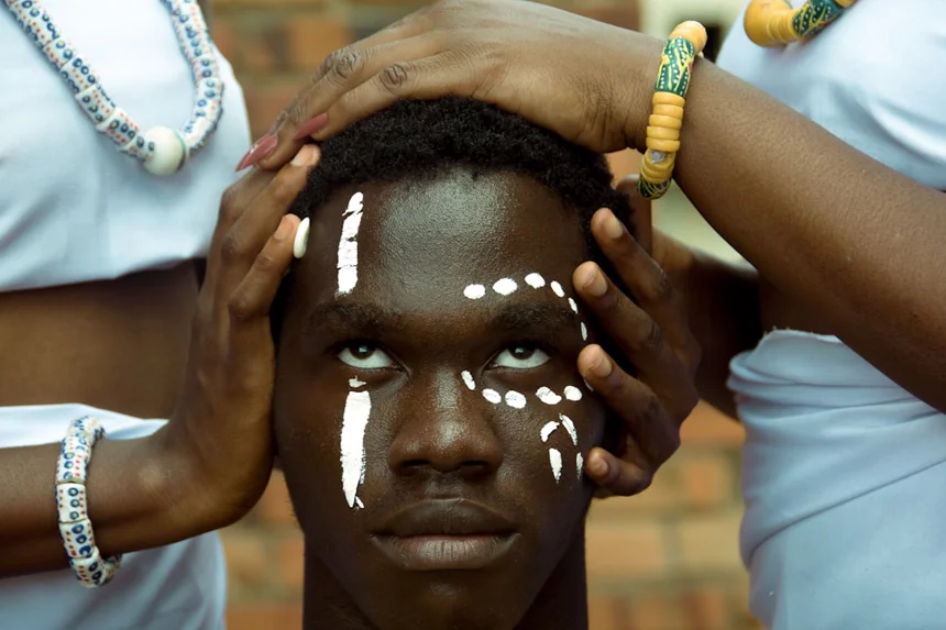 Vitiligo