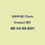 치아우식증 (Tooth Erosion) 원인 예방 치료 방법 총정리